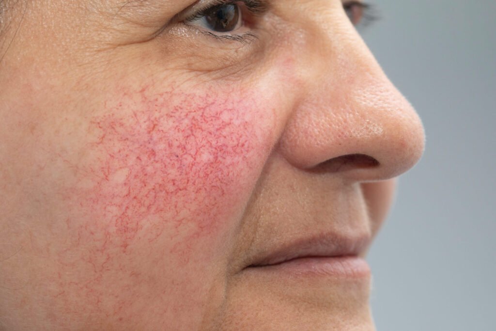 Rosacea side profil